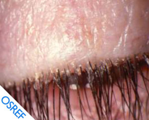 Demodex Blepharitis: Diagnosis And Treatment - Osref