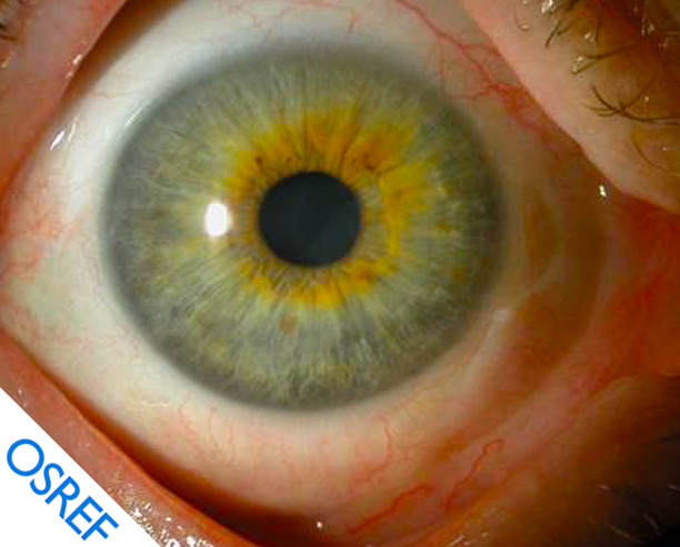 Amniotic Membrane Transplantation for Limbal Stem Cell Deficiency - Osref